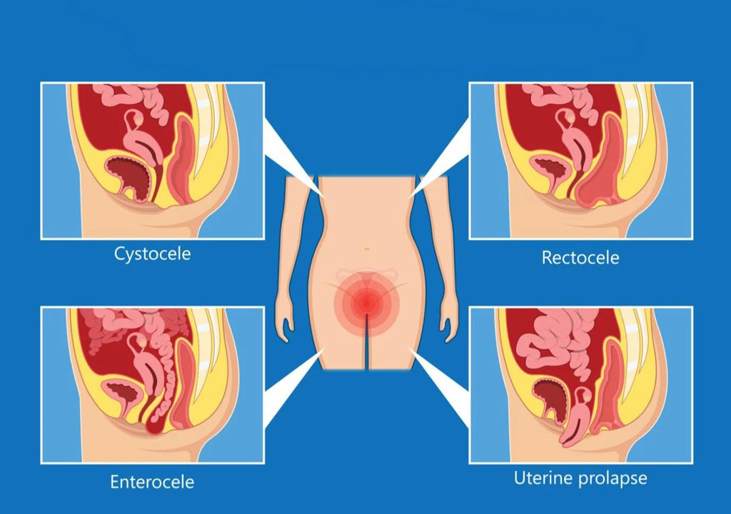 types of pelvic organ prolapse